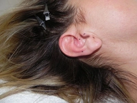 Kulak İçinde Yara Belirtileri ve Tedavisi