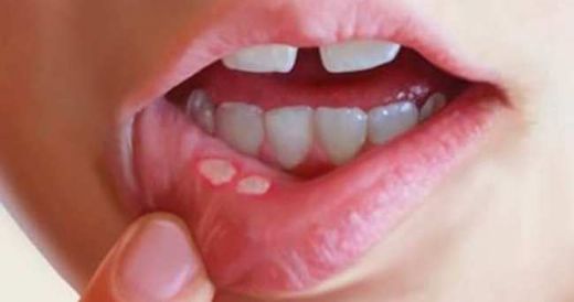 Dudak İçi Yara Belirtileri ve Tedavisi