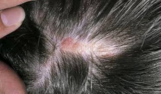 Saç Diplerinde Yara Belirtileri ve Tedavisi