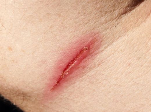 Yara Merhemi Kullanımı ve Faydaları Nelerdir?