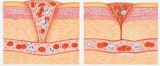 Yara Tipleri Nelerdir?