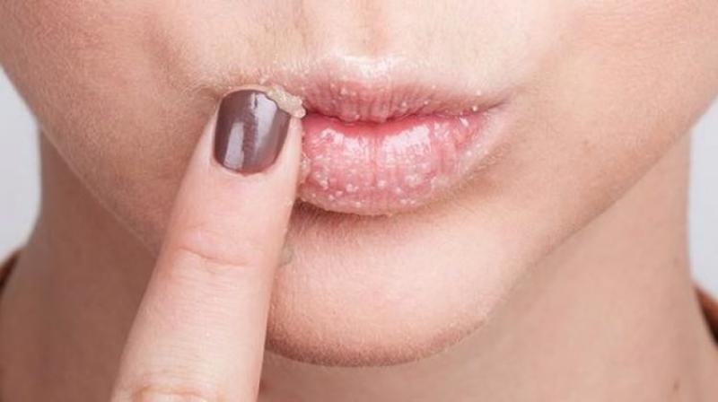 Ağızda Çıkan Beyaz Yaralar Belirtileri ve Tedavisi