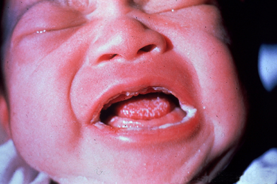 Bebeklerde Dil Yarası Belirtileri ve Tedavisi