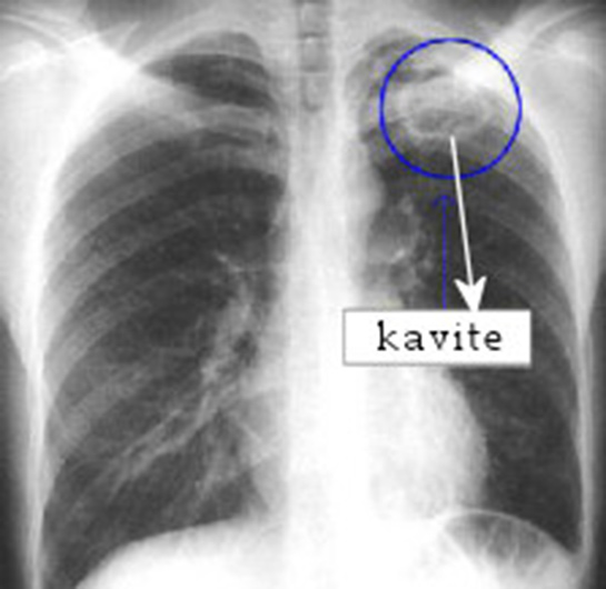 Ciğerde Yara Belirtileri ve Tedavisi