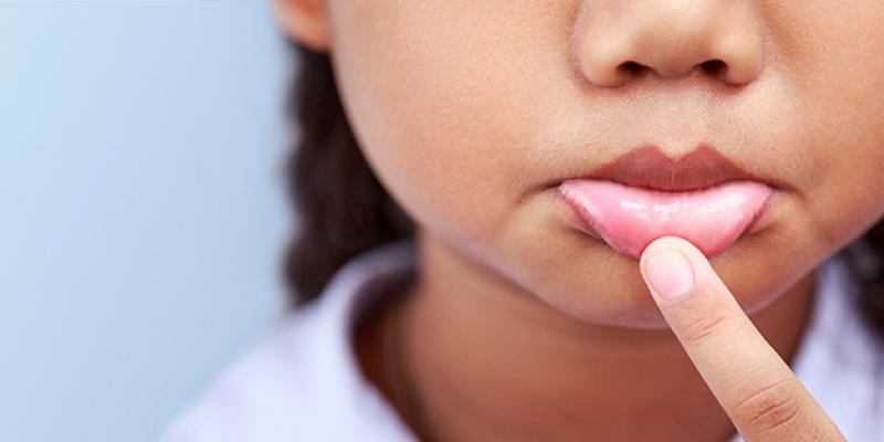 Damak Yarasına Ne İyi Gelir?