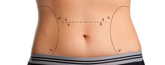 Göbek Deliğinde Yara Belirtileri ve Tedavisi
