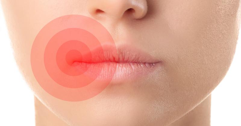 İç Dudak Yarası Belirtileri ve Tedavisi