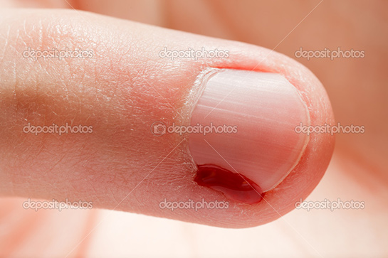 Tırnak Yarası Belirtileri ve Tedavisi