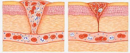Yara İyileşmesi Türleri ve Özellikleri